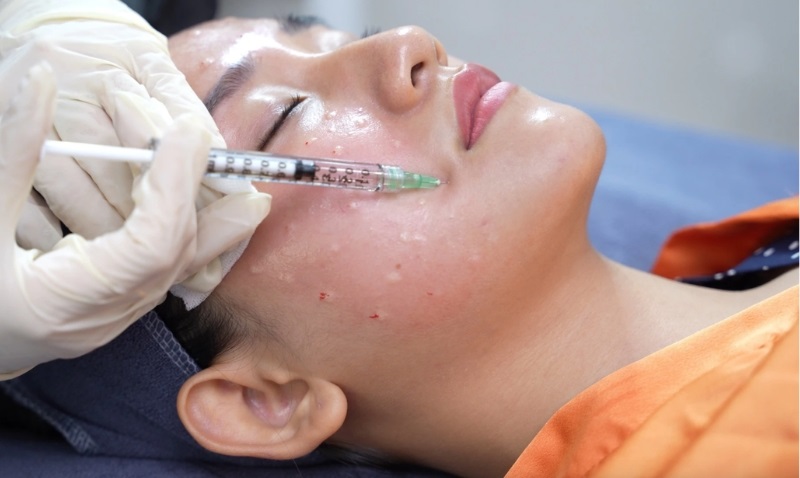 Đến spa trị nám da mặt bằng phương pháp tiêm meso