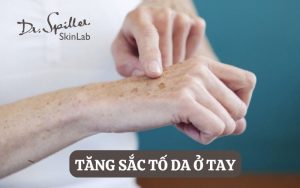 Những điều bạn nên biết về tình trạng tăng sắc tố da ở tay