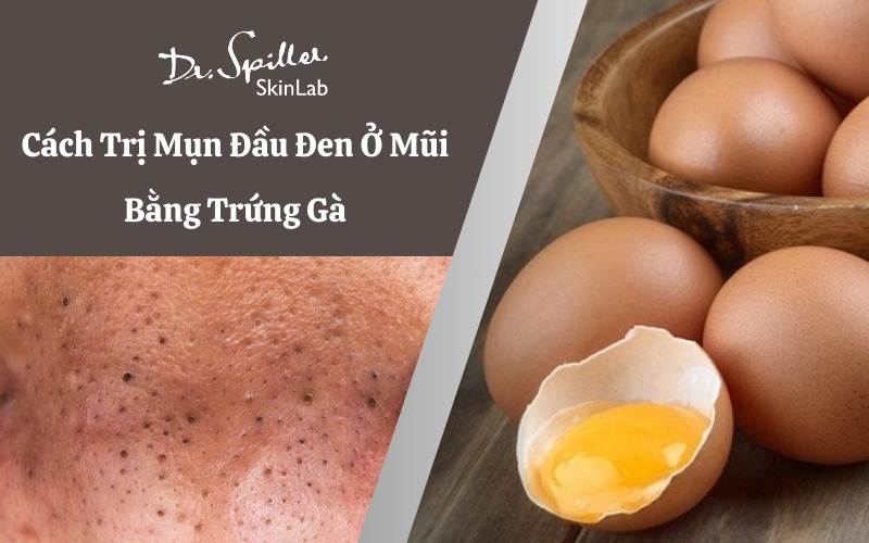 Bạn đã biết cách trị mụn đầu đen ở mũi bằng trứng gà hay chưa?