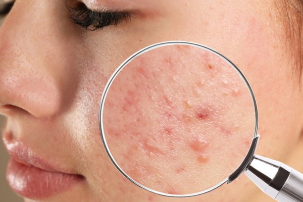 Đắp mặt nạ bột sắn dây đúng cách để phục hồi làn da khỏe đẹp rạng rỡ
