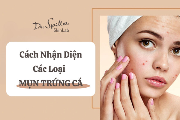 Phân biệt các loại mụn trứng cá và cách điều trị đúng chuẩn
