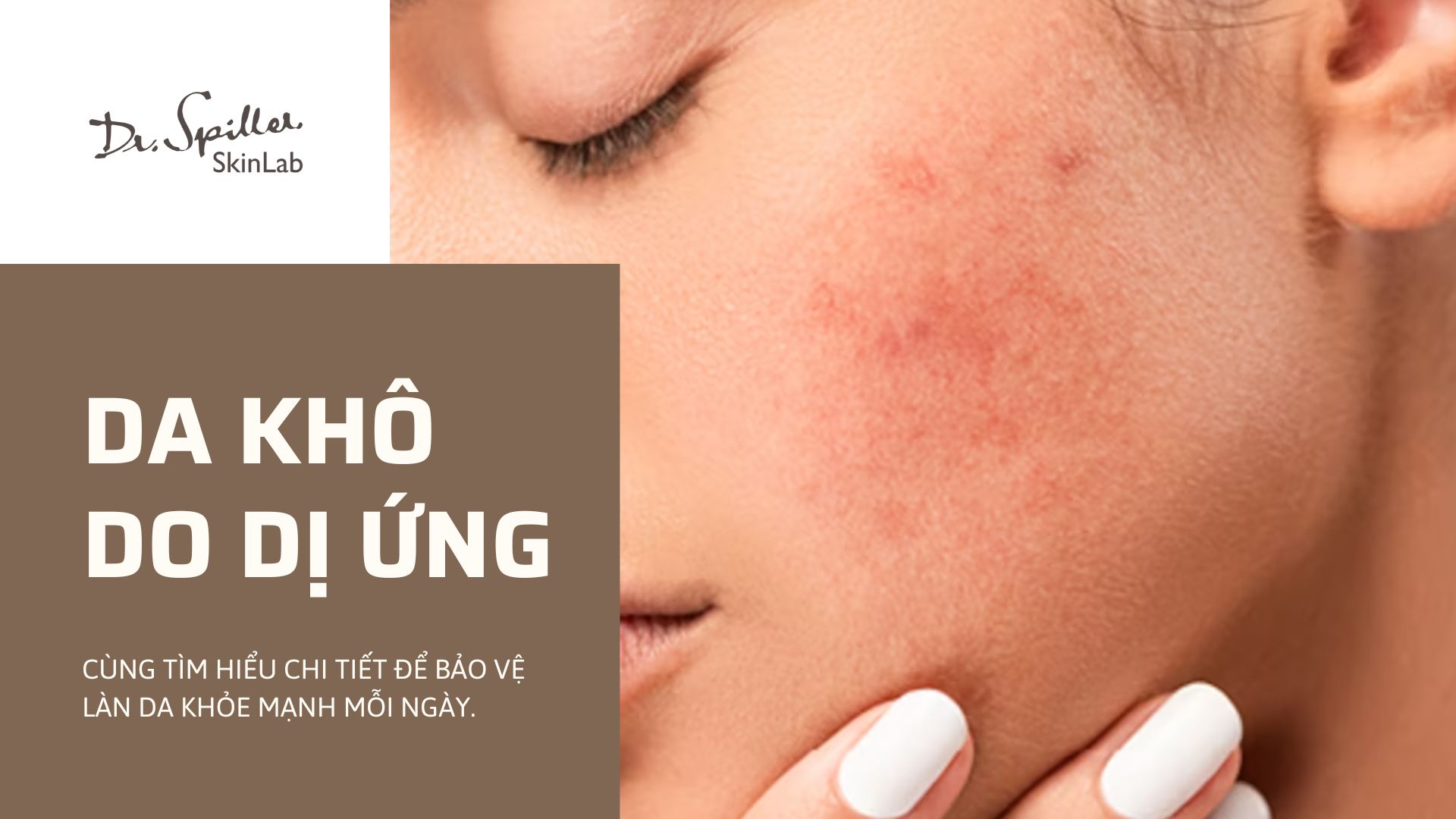 Da khô do kích ứng? Nguyên nhân và giải pháp