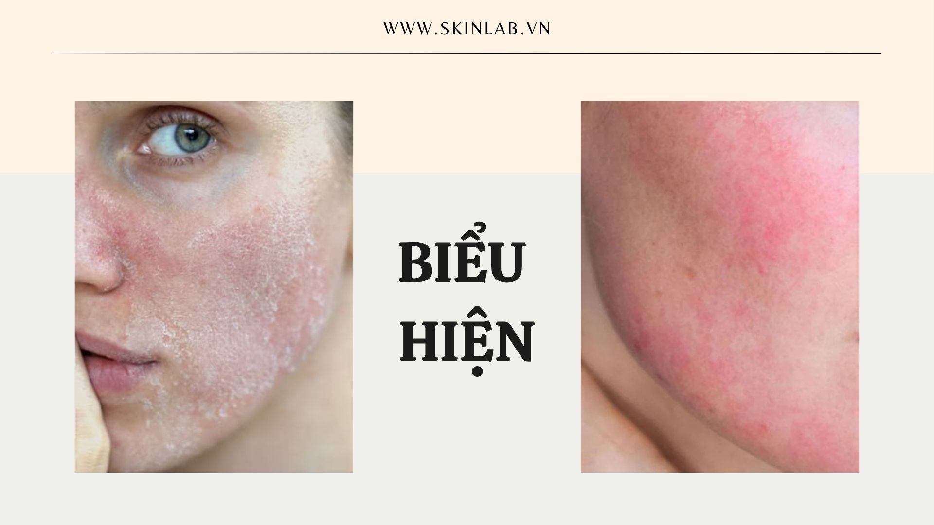 Các biểu hiện thường gặp của da khô do dị ứng