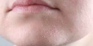 Nguyên nhân gây ra tình trạng da khô do mất nước