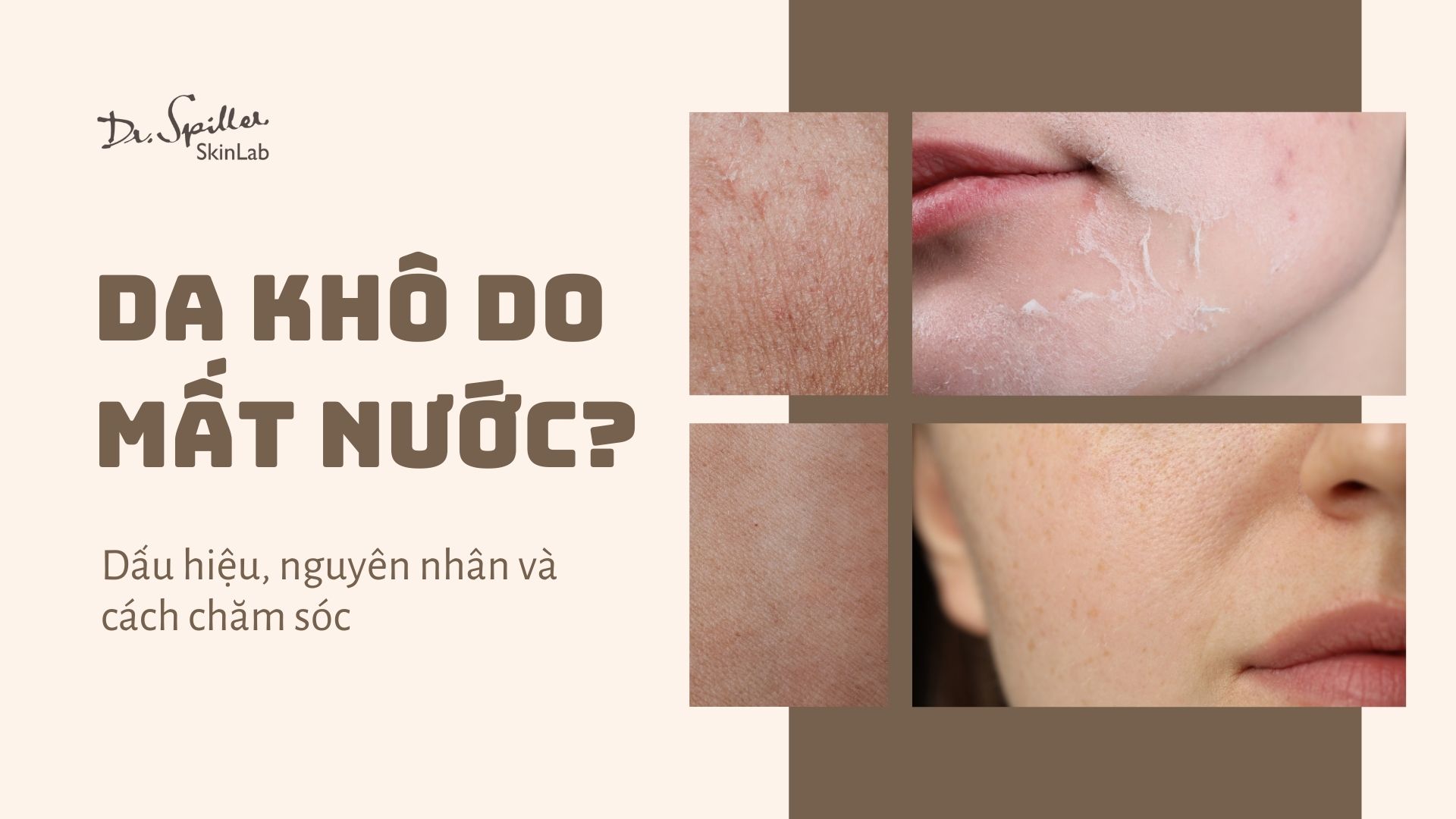 Da khô do mất nước: Dấu hiệu, nguyên nhân và cách chăm sóc