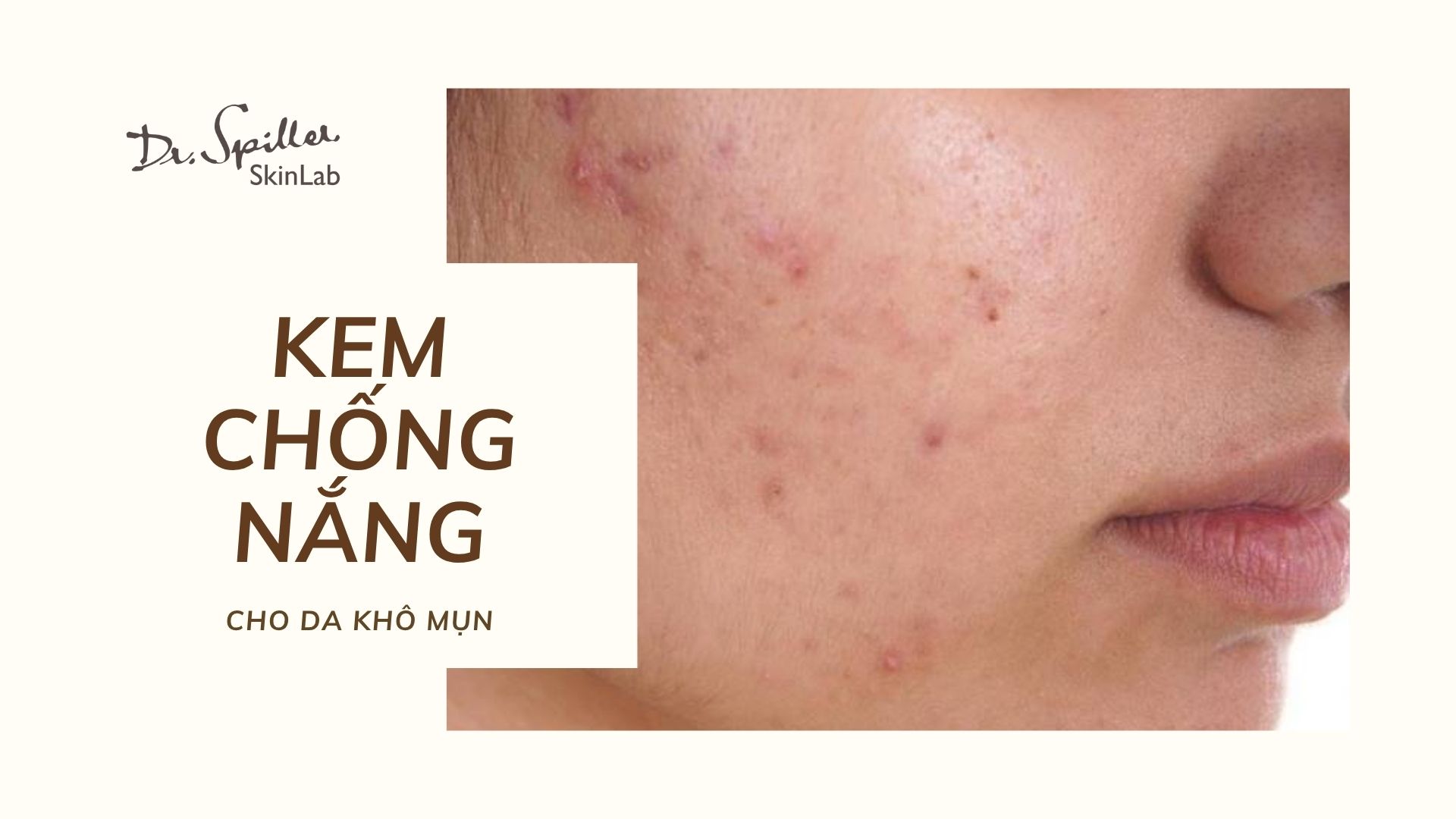 Kem chống nắng dành cho da khô mụn tốt nhất hiện nay