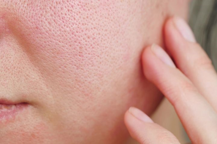 Nguyên nhân khiến lỗ chân lông to và khó cải thiện