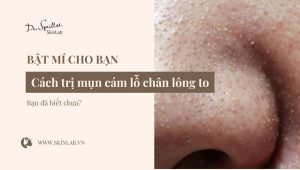 Cách trị mụn cám lỗ chân lông to hiệu quả, an toàn tại nhà