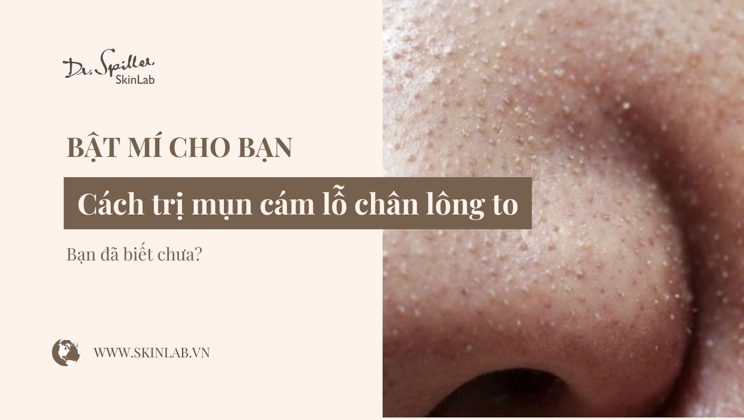 Cách trị mụn cám lỗ chân lông to hiệu quả, an toàn tại nhà