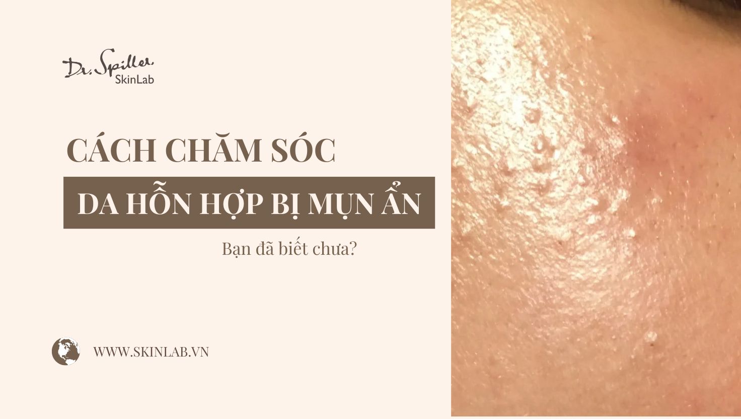 Chăm sóc da hỗn hợp bị mụn ẩn hiệu quả, an toàn tại nhà