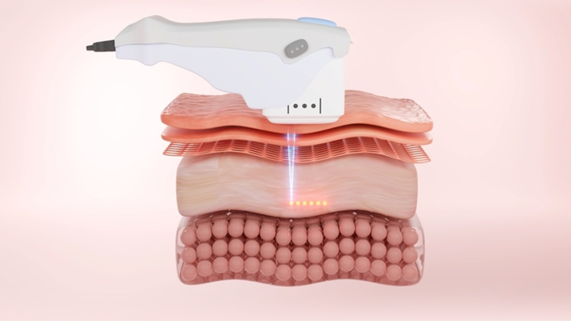 Trẻ hóa da hiệu quả bằng công nghệ HIFU chống lão hóa