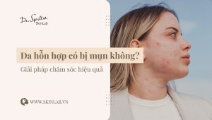 Da hỗn hợp có bị mụn không? Giải pháp chăm sóc hiệu quả
