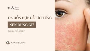 Da hỗn hợp dễ kích ứng nên dùng gì? Giải pháp từ chuyên gia