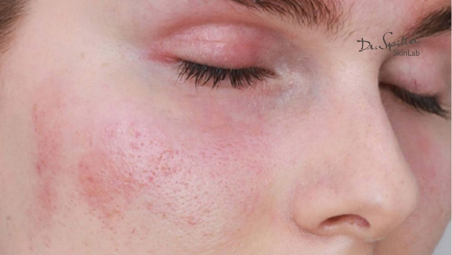 Hiểu đúng về da hỗn hợp dễ kích ứng