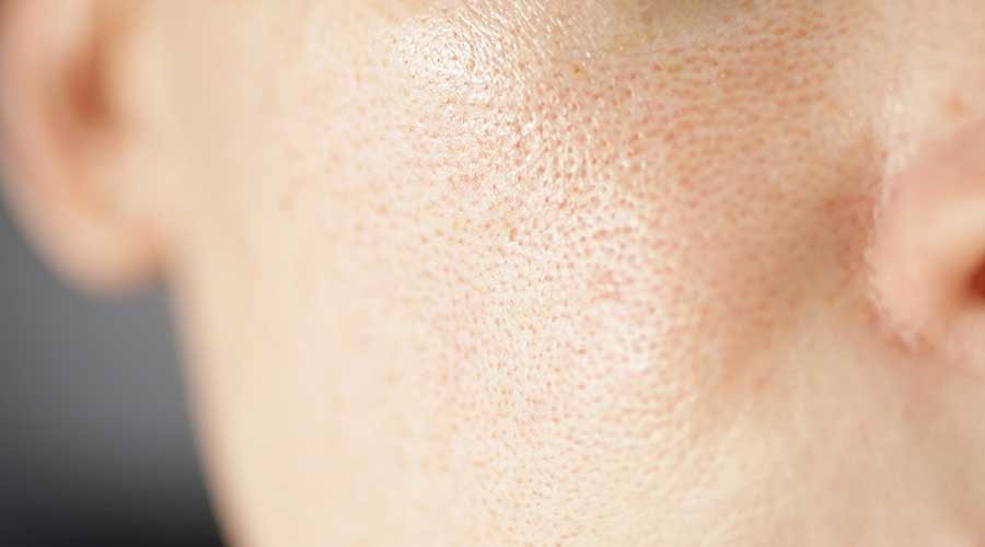 Nguyên nhân khiến da mặt nhờn và lỗ chân lông to