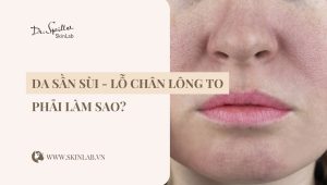 Da mặt sần sùi lỗ chân lông to: Cách cải thiện hiệu quả