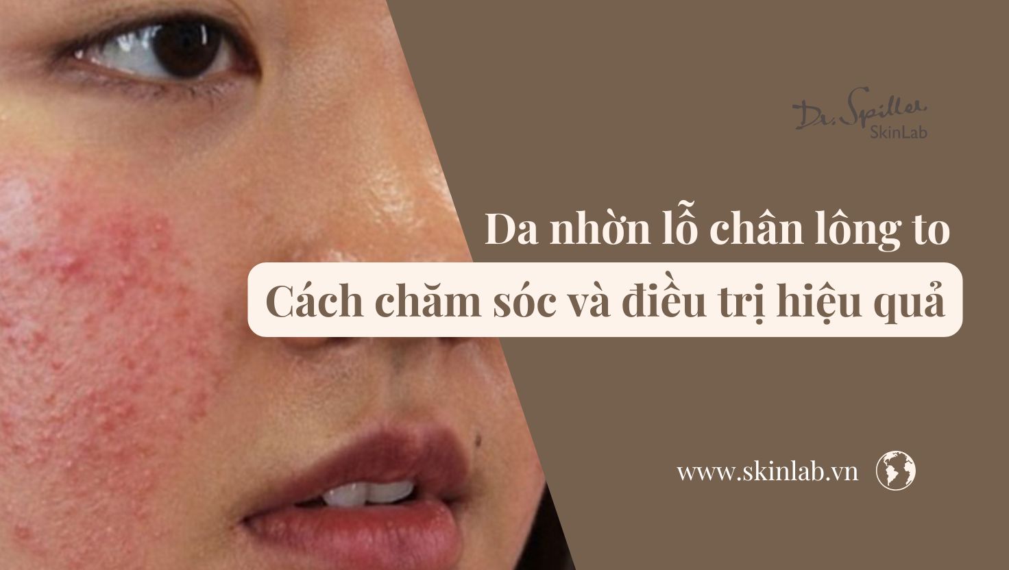 Da nhờn lỗ chân lông to: Cách chăm sóc và điều trị hiệu quả