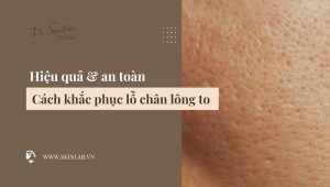 Cách khắc phục lỗ chân lông to hiệu quả và an toàn
