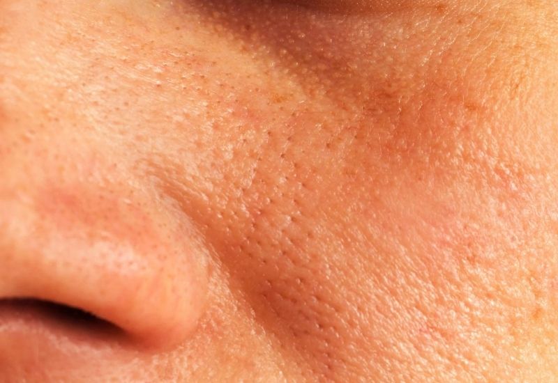 Dấu hiệu nhận biết lão hóa da ở tuổi dậy thì: Lỗ chân lông to, sần sùi