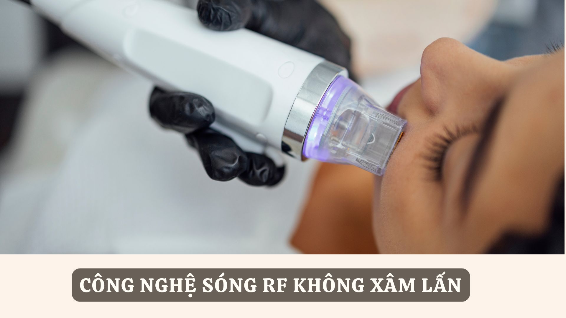 Công nghệ sóng RF không xâm lấn - Liệu trình trẻ hoá da tại spa
