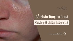 Lỗ chân lông to ở má: Cách cải thiện nhanh chóng và an toàn