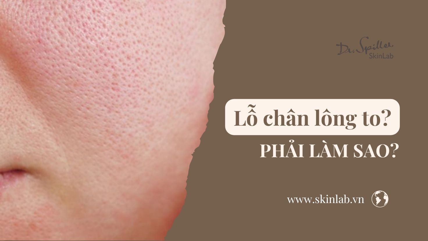 Lỗ chân lông to phải làm sao? Cách cải thiện hiệu quả