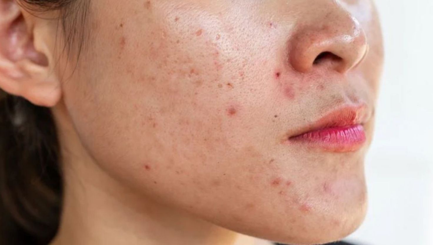 Làn da dầu mụn và lỗ chân lông to: Hiểu rõ để chăm sóc đúng cách