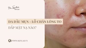 Mặt nạ cho da dầu mụn lỗ chân lông to hiệu quả nhất