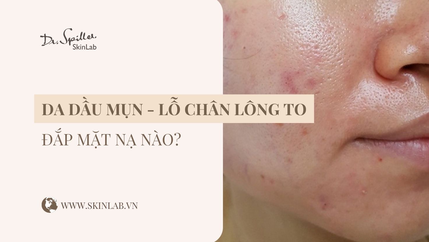 Mặt nạ cho da dầu mụn lỗ chân lông to hiệu quả nhất