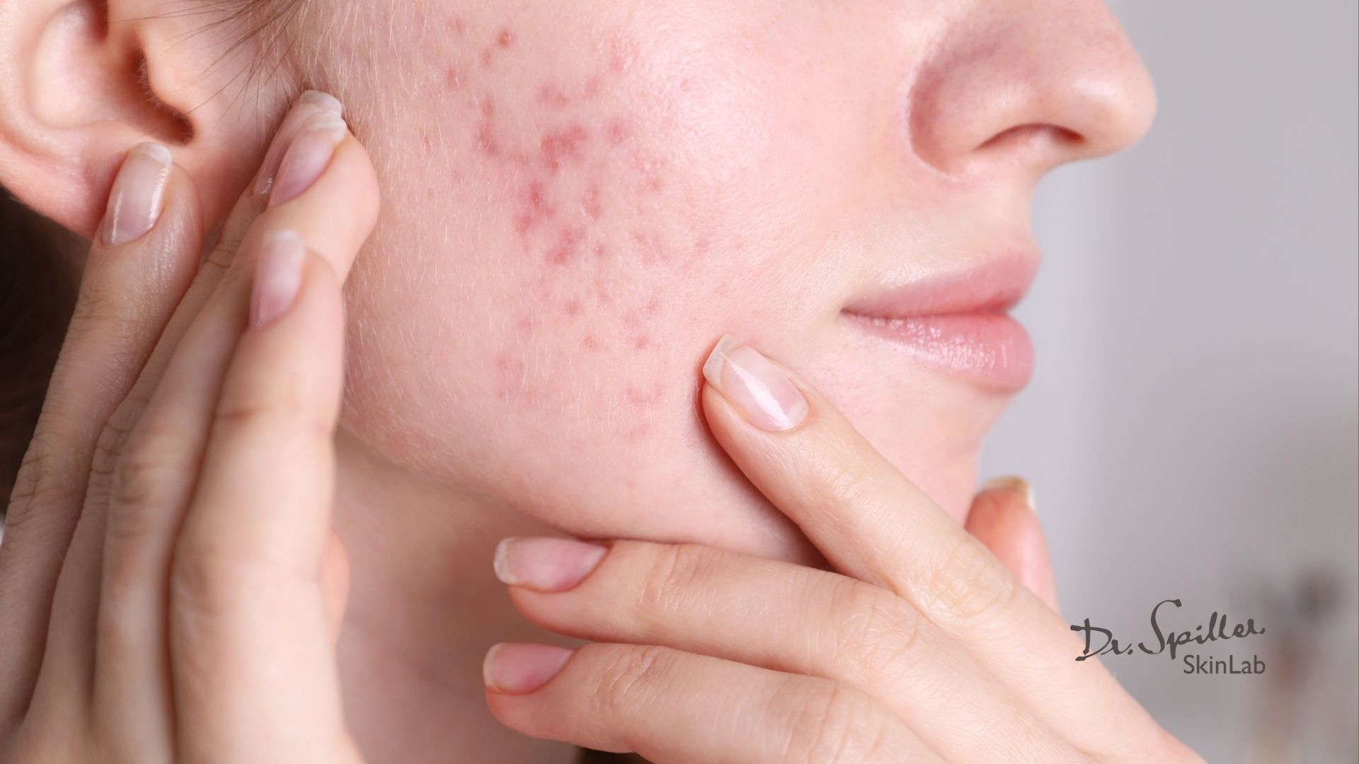 Các bước xây dựng routine chống lão hóa da dầu mụn khoa học