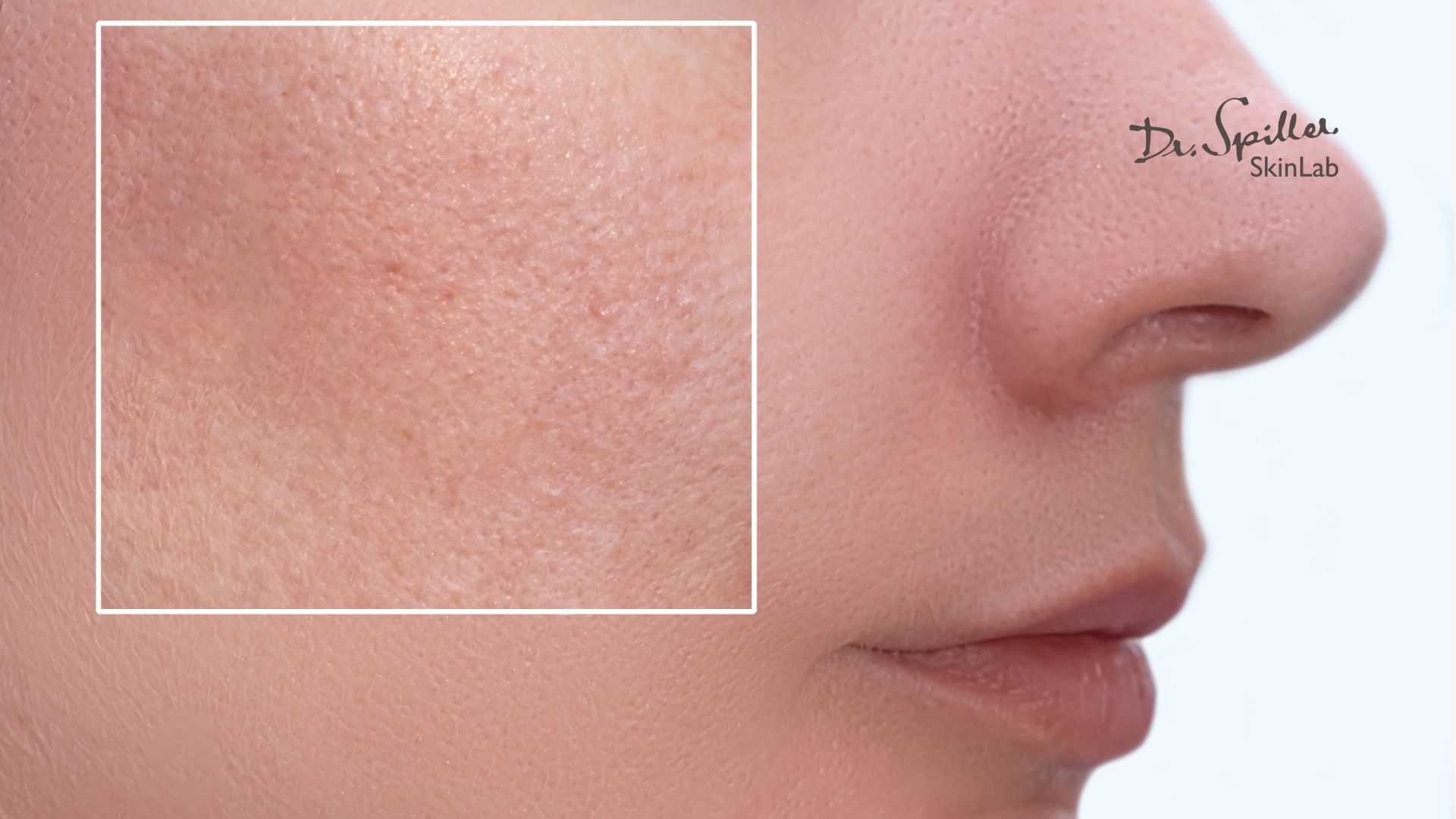 Sản phẩm cần tránh cho da hỗn hợp vào mùa lạnh: Đặc điểm của da hỗn hợp vào mùa lạnh