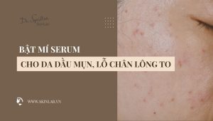 Serum cho da dầu mụn lỗ chân lông to hiệu quả 2025