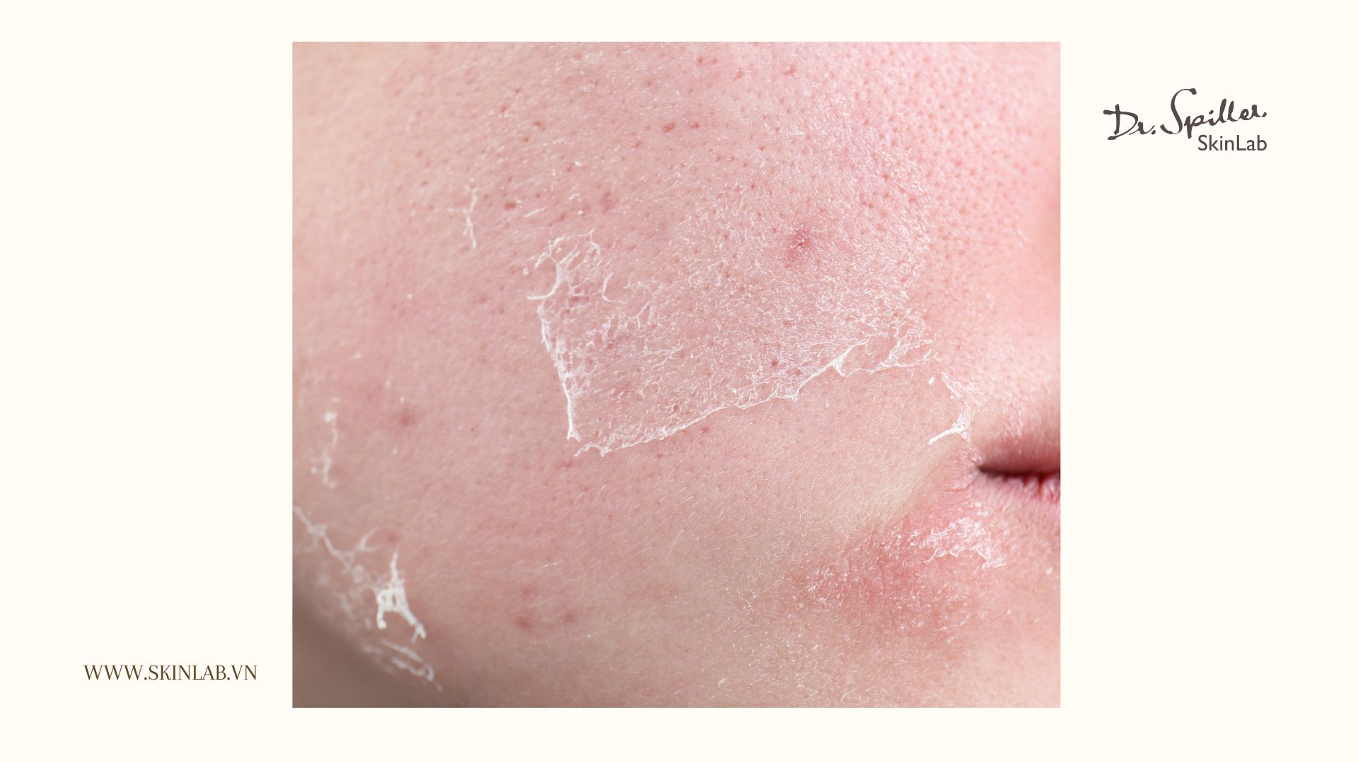 Tại sao da khô cần một skincare routine cho da khô riêng biệt?