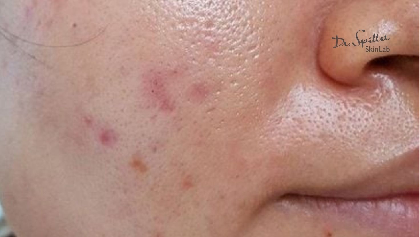 Nguyên nhân khiến da nhờn dễ bị lỗ chân lông to