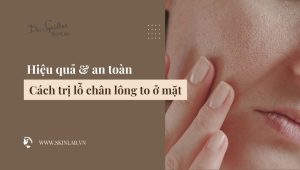 Cách trị lỗ chân lông to ở mặt hiệu quả và an toàn