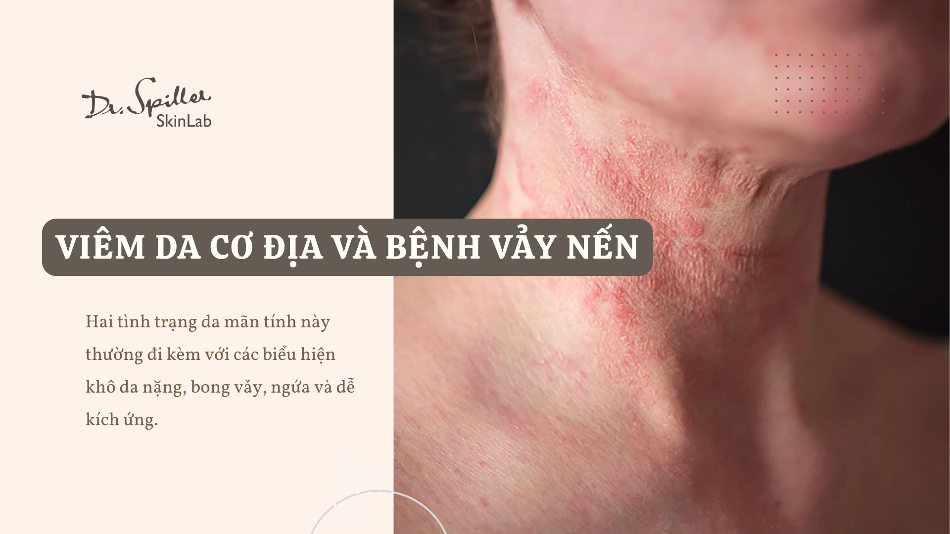 Vì sao da bị khô? Có thể do bệnh lý da và tình trạng sức khỏe liên quan