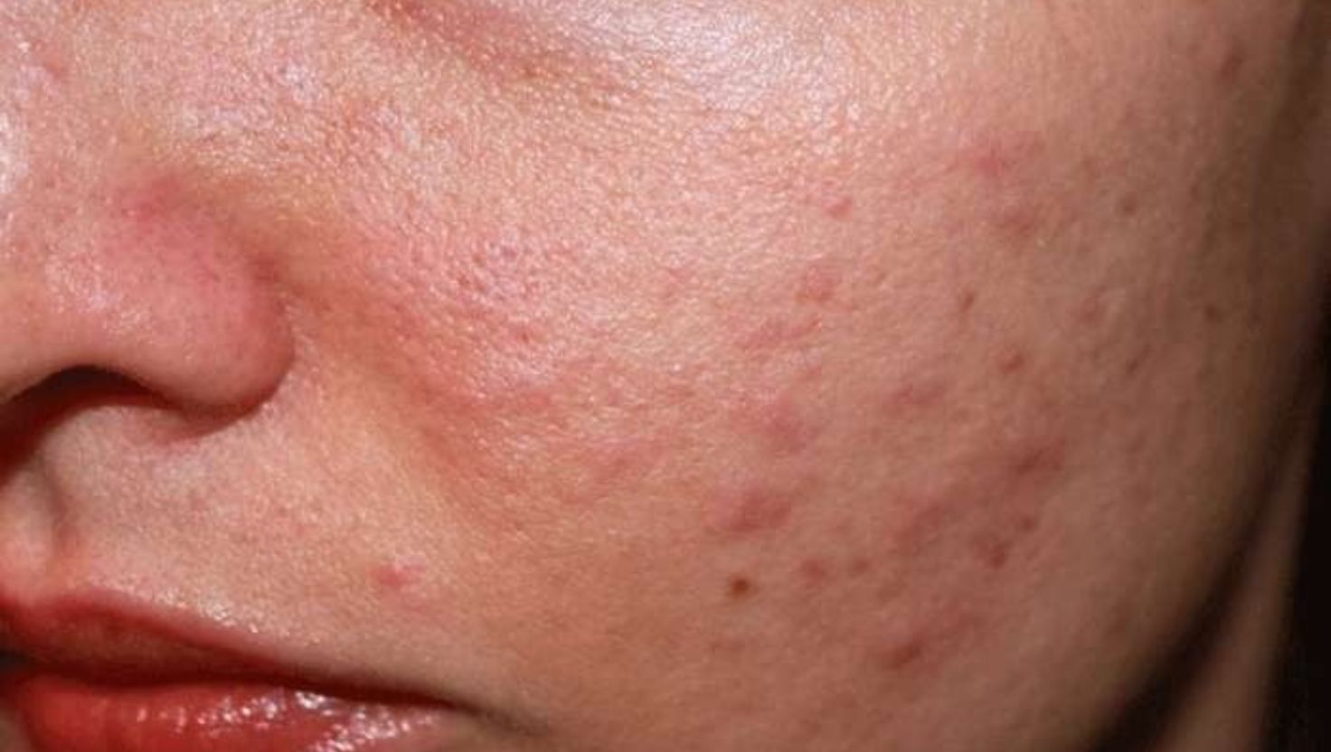 Người có da dầu, mụn: Giúp làm sạch lỗ chân lông và giảm viêm.