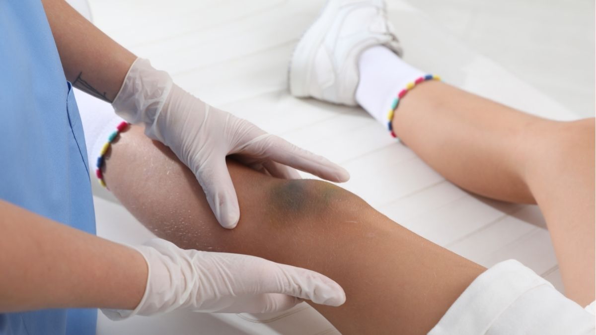 Các cách trị thâm đầu gối hiệu quả, an toàn và dễ thực hiện