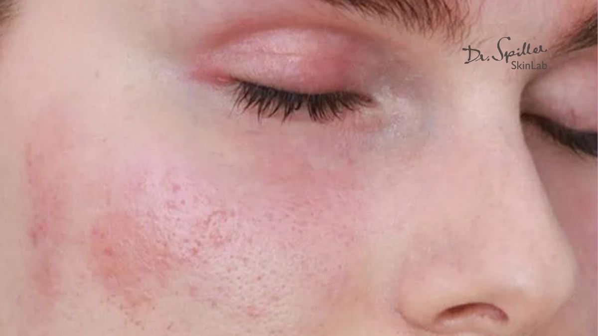 Vì sao nên chọn nguyên liệu tự nhiên cho da nhạy cảm?