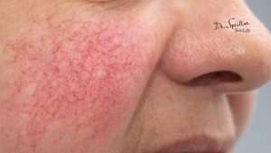 Cách chữa giãn mao mạch ở mặt hiệu quả và an toàn