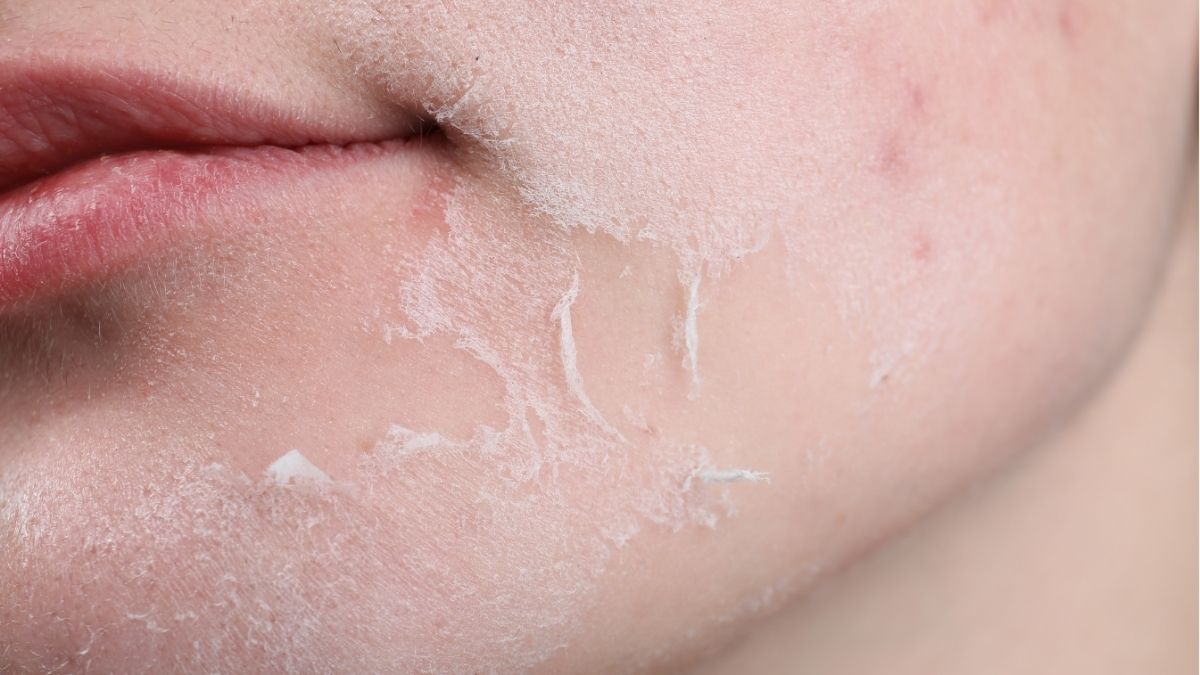 Khi nào không nên peel da mặt?