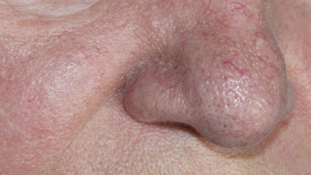 Giãn mao mạch mũi: Nguyên nhân và cách điều trị hiệu quả