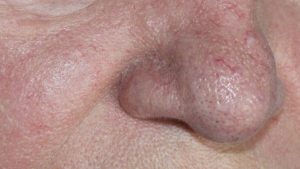 Giãn mao mạch mũi: Nguyên nhân và cách điều trị hiệu quả