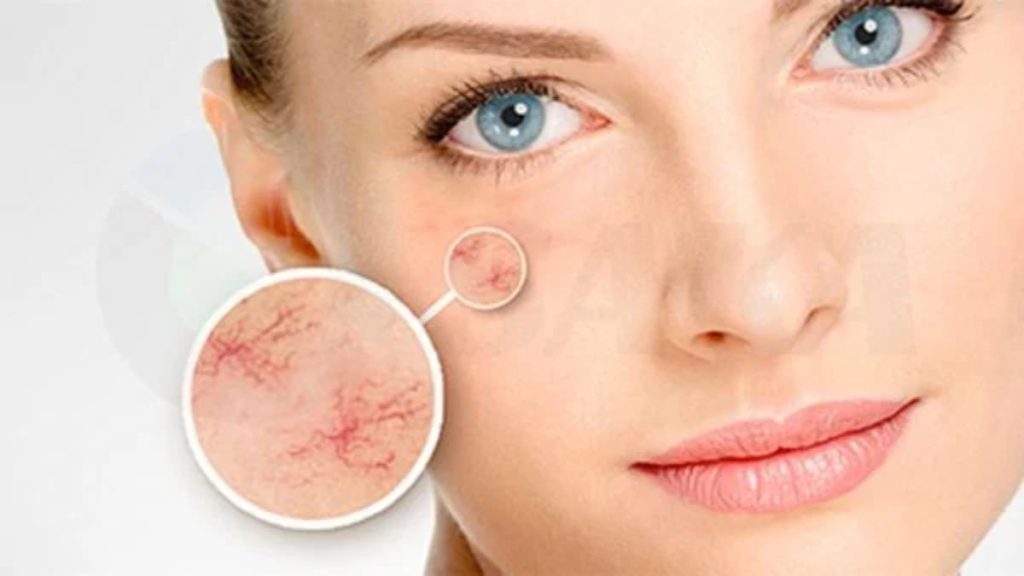 Nguyên nhân phổ biến dẫn đến giãn tĩnh mạch ở mặt