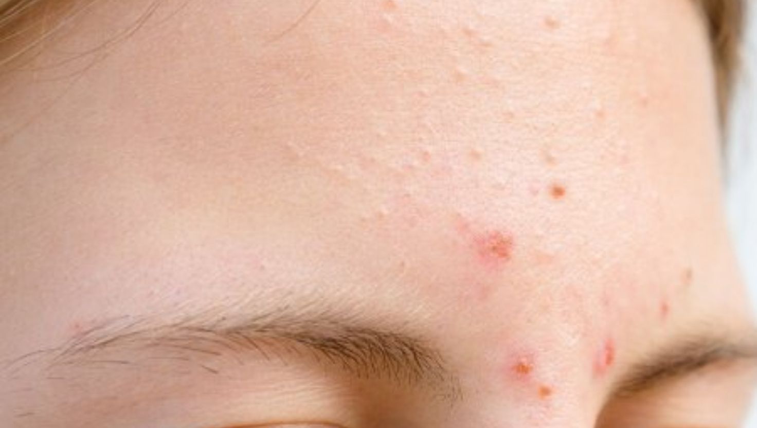 Kem chống nắng cho da nhạy cảm mụn: Dịu nhẹ và hiệu quả