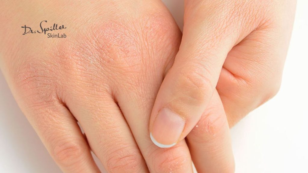 Nguyên nhân phổ biến khiến da tay khô nứt nẻ