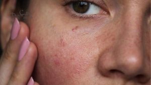 Mẹo dân gian chữa mẩn đỏ da nhạy cảm hiệu quả tại nhà