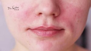 Tại sao nên chọn mẹo dân gian để cải thiện da nhạy cảm?