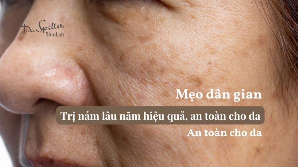 Mẹo dân gian trị nám lâu năm hiệu quả, an toàn cho da