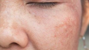 Nám nông là gì? đặc điểm thế nào?